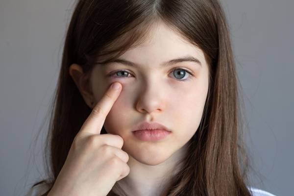 girl with pinkeye pointing with finger