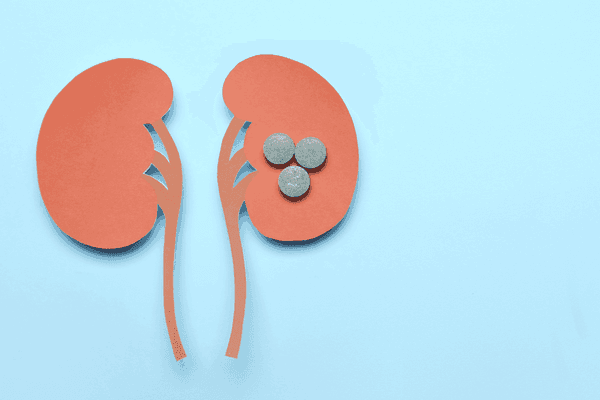 cardboard illustration of kidney stones