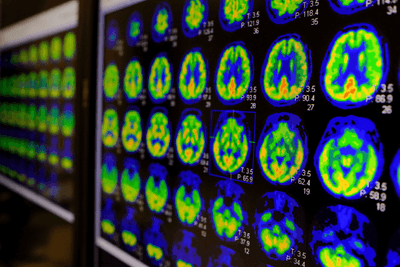 PET-CT scan of Human Brain